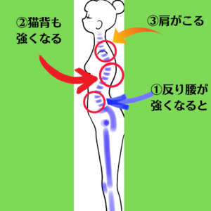 反り腰が引き起こす肩こりもあります