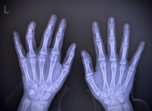 ばね指の原因の説明です